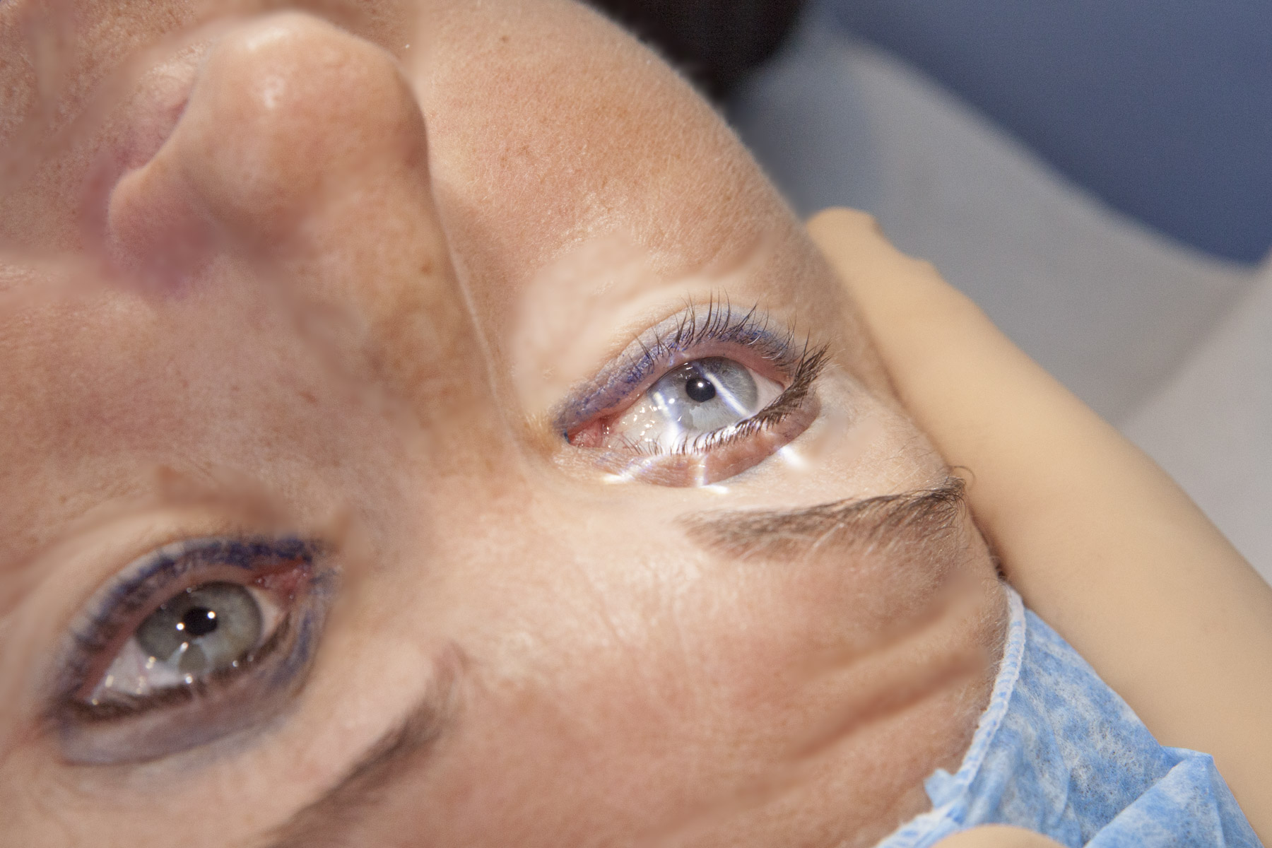 Traitement laser ophtalmologique en cours