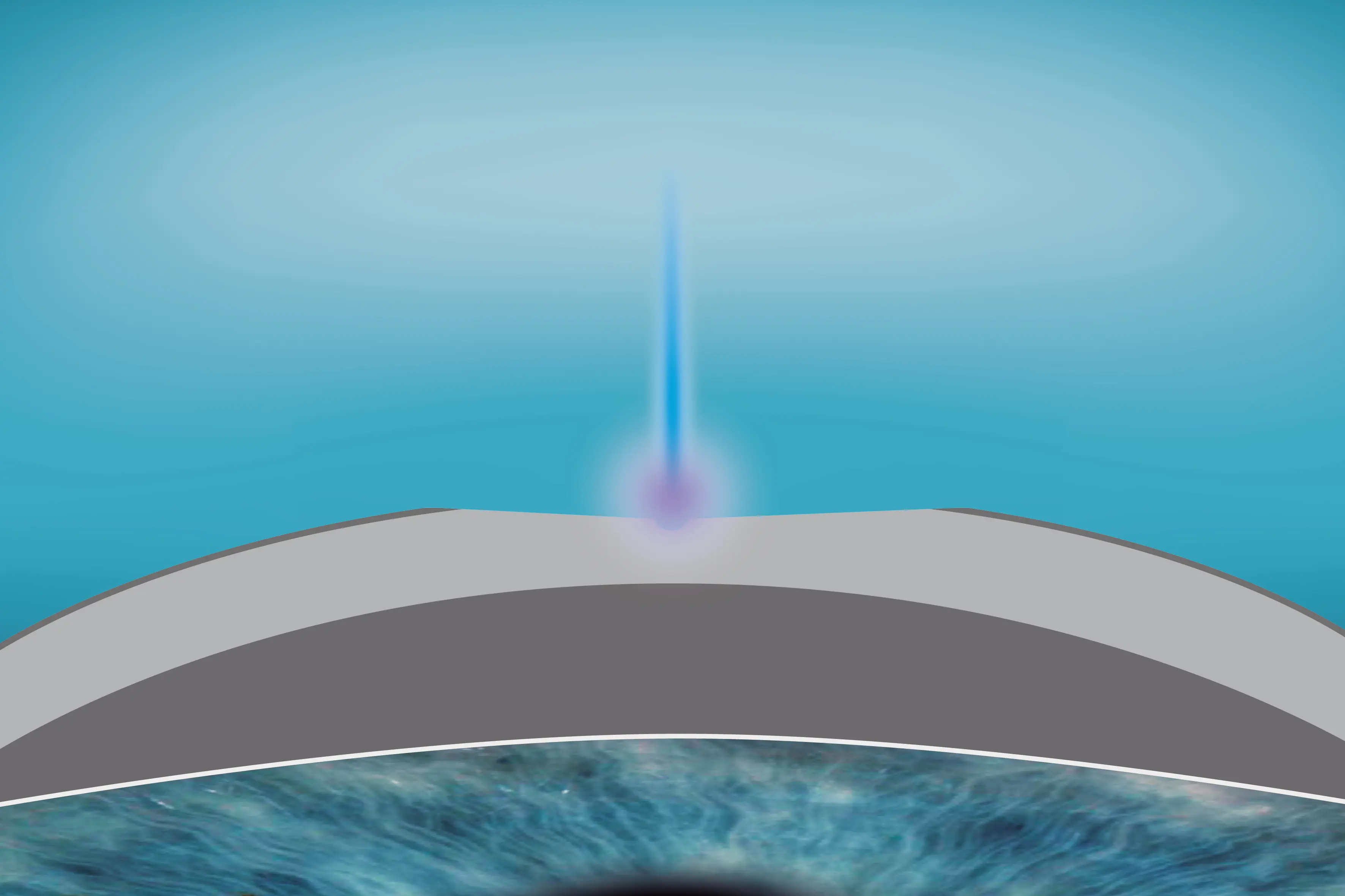 Illustration de l'ablation du composant épithélial dans la procédure SmartSurfACE