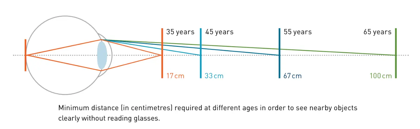 Profil de traitement PresbyMax Monovision montrant les zones de correction